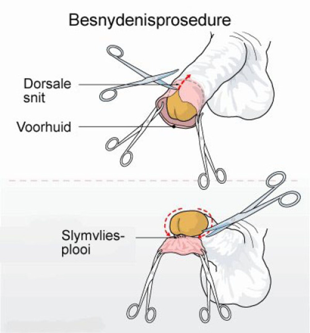 Mannenbesnijdenis Ovt Vpro